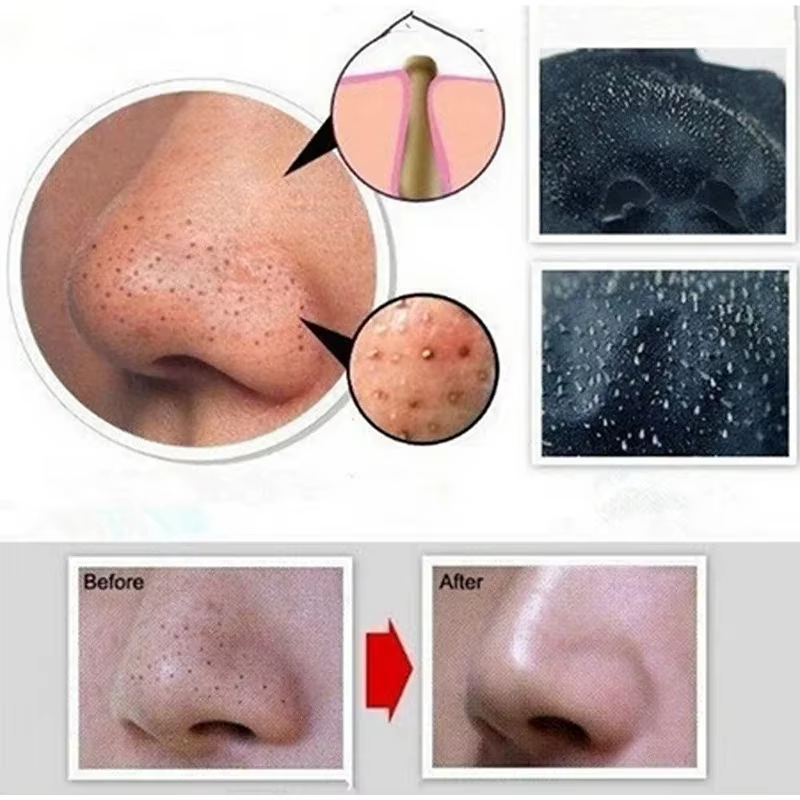 Masque dissolvant de points noirs pour le visage