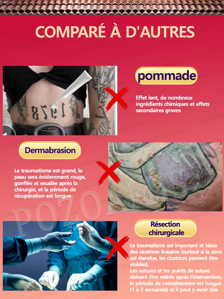 Thérapie par la lumière bleue pour les tatouages : élimination indolore des tatouages, kits à prix réduits disponibles.