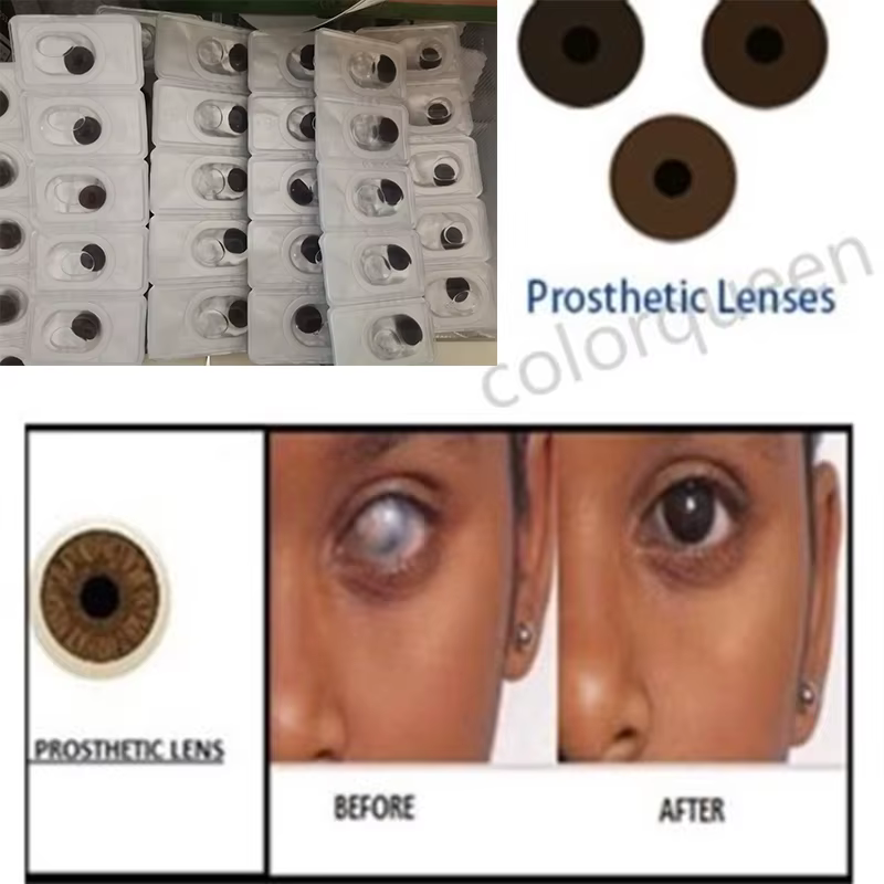 Lentilles de contact prothétiques pour les personnes souffrant de troubles oculaires