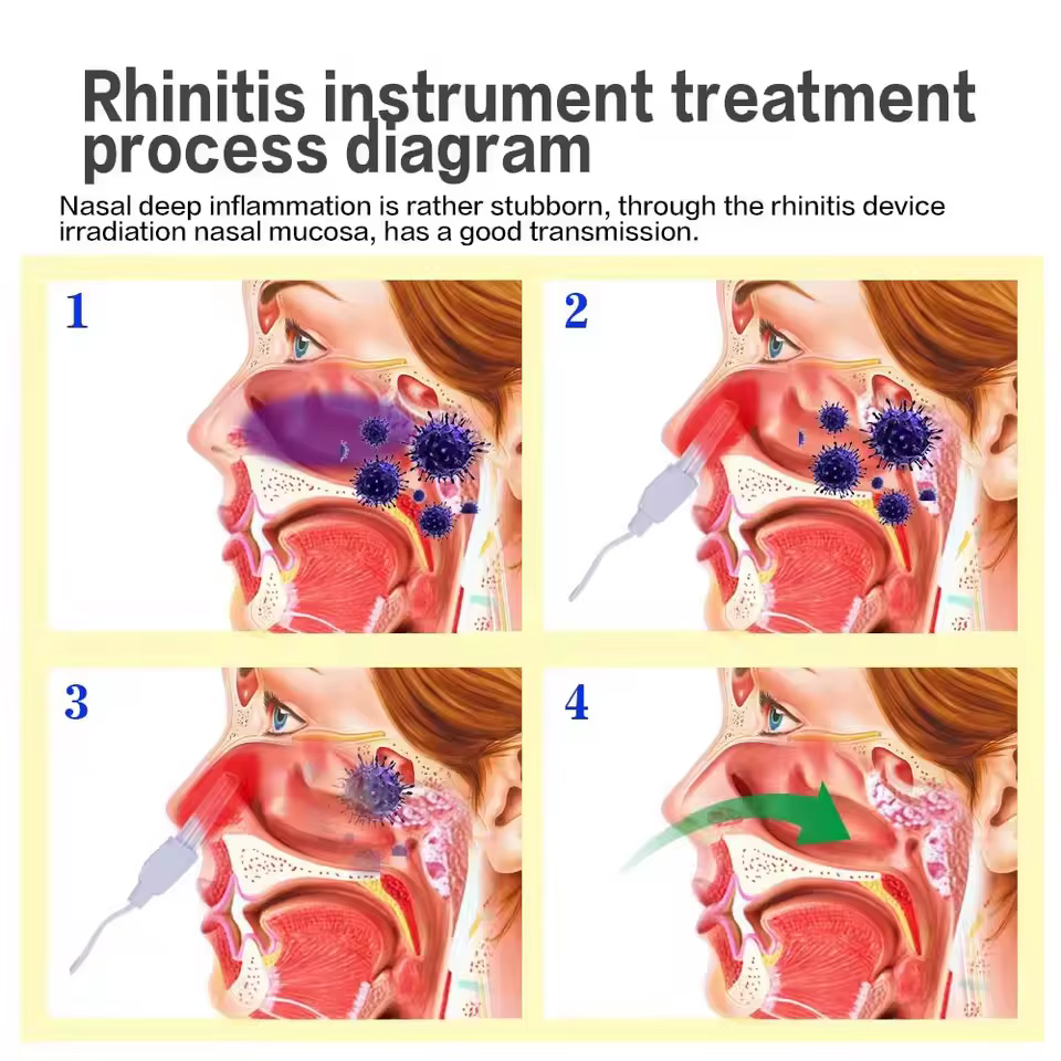 Traitement de la rhinite du nez et de la sinusite, thérapie au Laser BioNase, fièvre du foin, Massage du nez à impulsion basse fréquence, Machine de traitement des éternuements