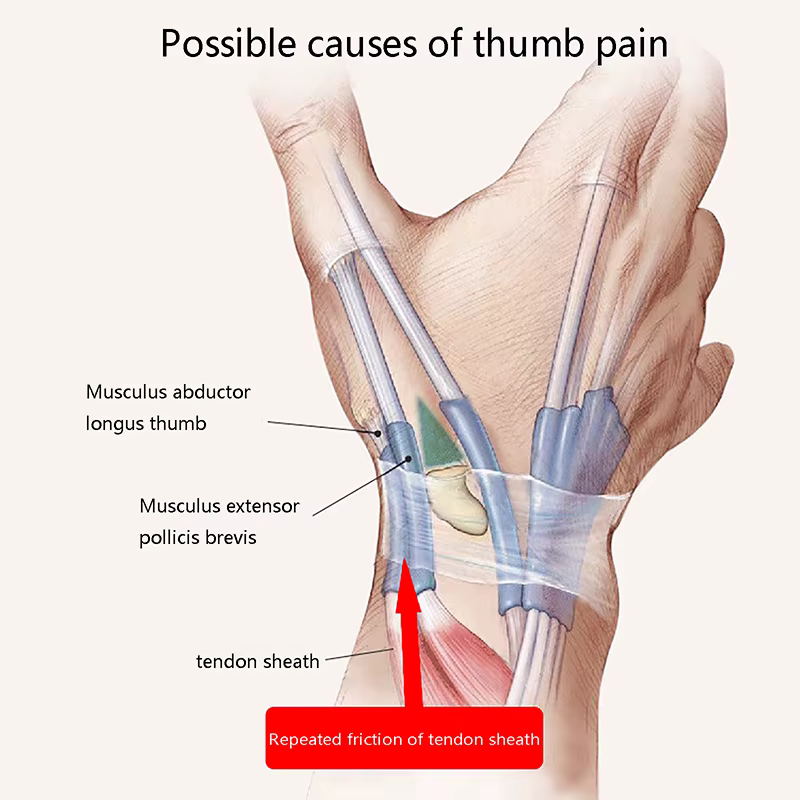 Attelle de poignet entorse avec stabilisateur de pouce, unisexe, tendinite, déclencheur, doigt, arthriti oto, pouce, déclencheur de main