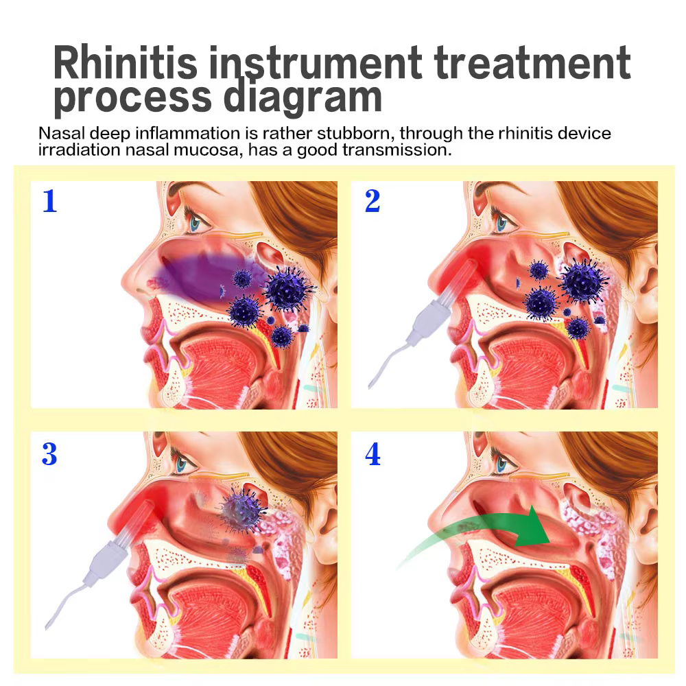 Appareil de thérapie laser basse fréquence pour le traitement de la sinusite, de la rhinite, de la fièvre des foins, du nez qui coule et des éternuements